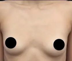 Breast Augmentation Before & After Patient #423