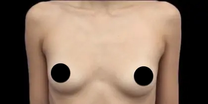 Breast Augmentation Before & After Patient #423