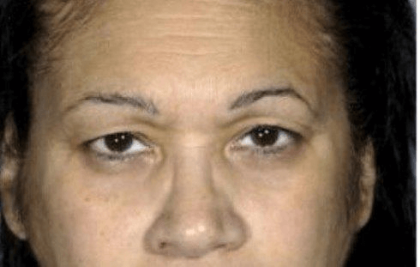 Blepharoplasty Before & After Patient #389