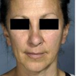 Facelift Before & After Patient #574