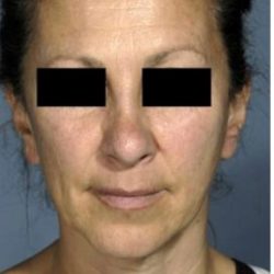 Facelift Before & After Patient #574