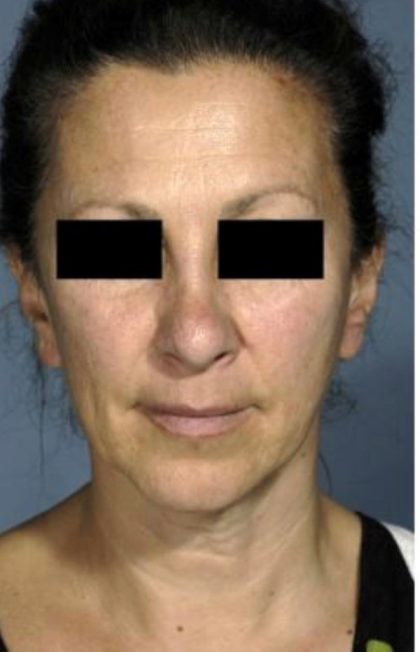 Facelift Before & After Patient #574