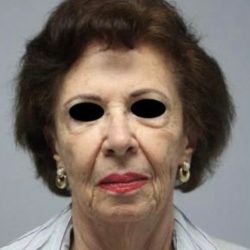 Facelift Before & After Patient #575