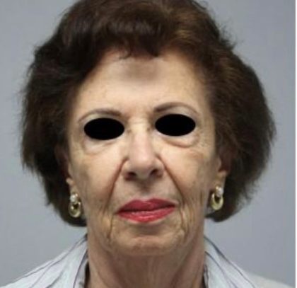 Facelift Before & After Patient #575