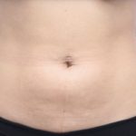 Liposuction/Liposculpture Before & After Patient #598