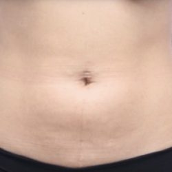 Liposuction/Liposculpture Before & After Patient #598