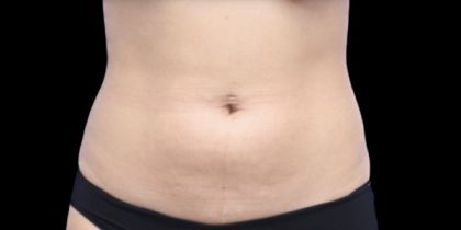 Liposuction/Liposculpture Before & After Patient #598