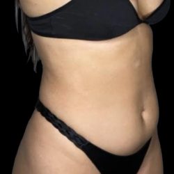 Liposuction/Liposculpture Before & After Patient #599