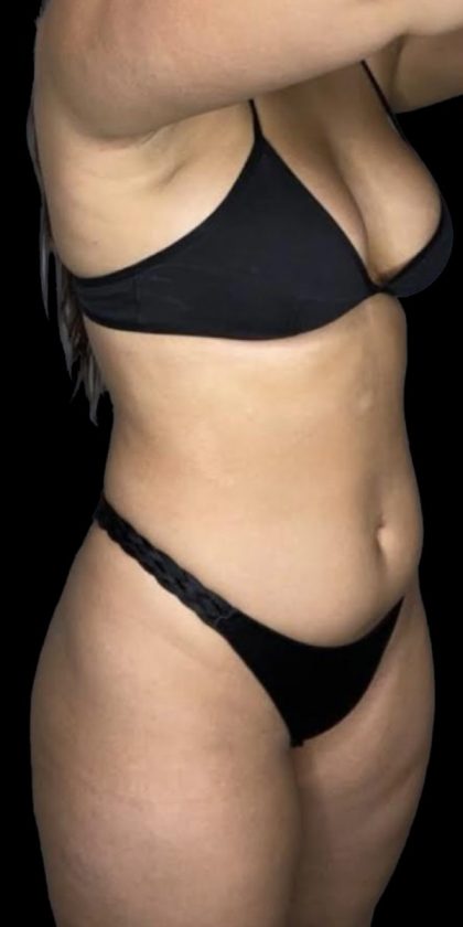 Liposuction/Liposculpture Before & After Patient #599