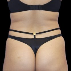 Brazilian Butt Lift Before & After Patient #403