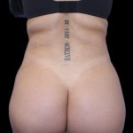 Liposuction/Liposculpture Before & After Patient #600