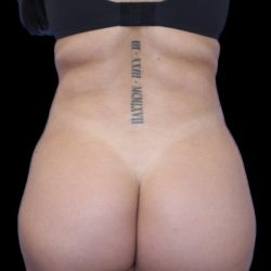 Liposuction/Liposculpture Before & After Patient #600