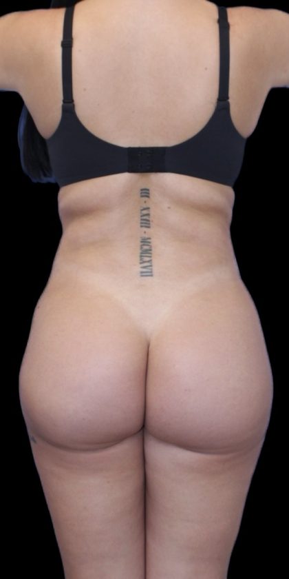 Liposuction/Liposculpture Before & After Patient #600