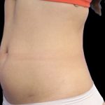 Liposuction/Liposculpture Before & After Patient #602