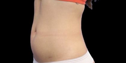 Liposuction/Liposculpture Before & After Patient #602