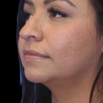 Primary Rhinoplasty Before & After Patient #826