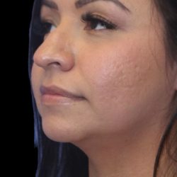 Primary Rhinoplasty Before & After Patient #826
