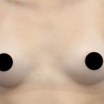 Breast Augmentation Before & After Patient #424