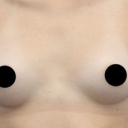 Breast Augmentation Before & After Patient #424