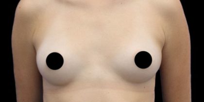 Breast Augmentation Before & After Patient #424
