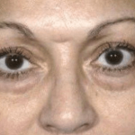 Blepharoplasty Before & After Patient #390