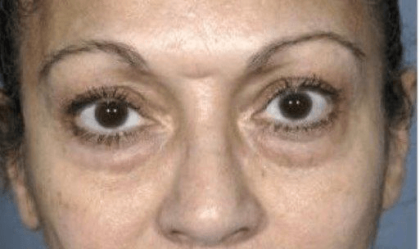 Blepharoplasty Before & After Patient #390