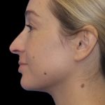 Primary Rhinoplasty Before & After Patient #839