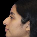 Primary Rhinoplasty Before & After Patient #840