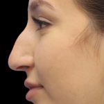 Primary Rhinoplasty Before & After Patient #842