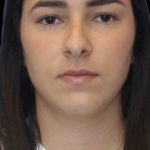 Primary Rhinoplasty Before & After Patient #843