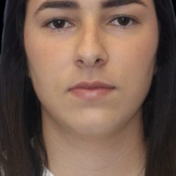 Primary Rhinoplasty Before & After Patient #843