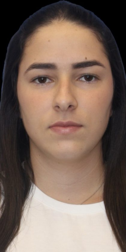 Primary Rhinoplasty Before & After Patient #843