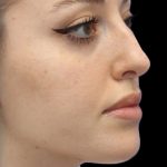 Primary Rhinoplasty Before & After Patient #857