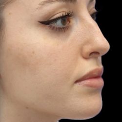 Primary Rhinoplasty Before & After Patient #857