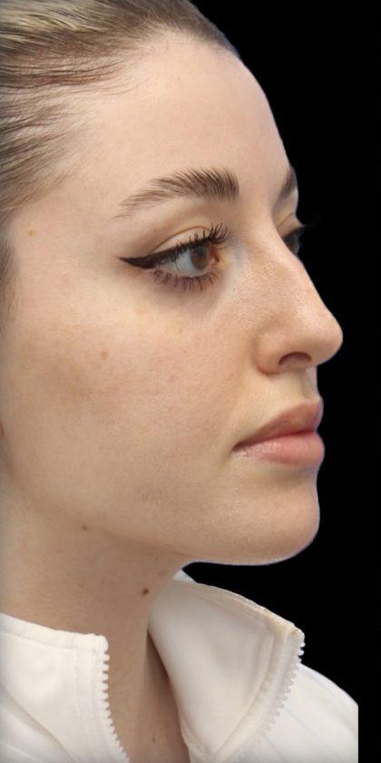 Primary Rhinoplasty Before & After Patient #857