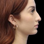 Primary Rhinoplasty Before & After Patient #858