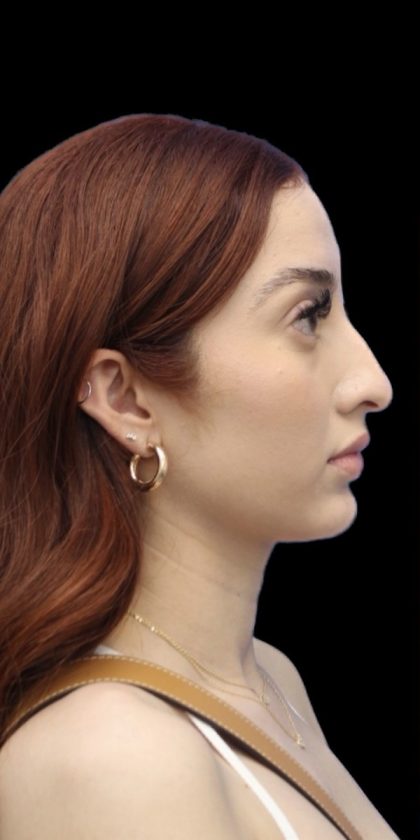 Primary Rhinoplasty Before & After Patient #858