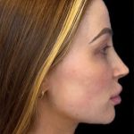 Dermal Fillers Before & After Patient #954