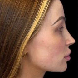 Dermal Fillers Before & After Patient #954