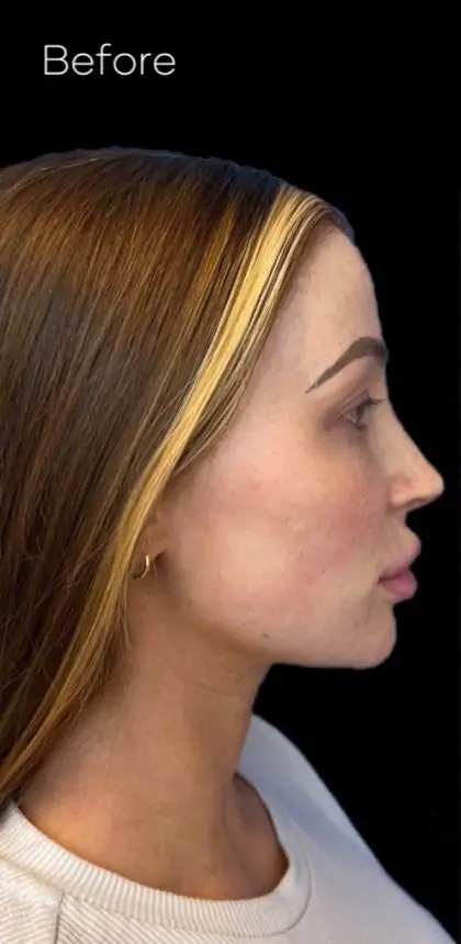 Dermal Fillers Before & After Patient #954
