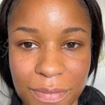 Dermal Fillers Before & After Patient #955