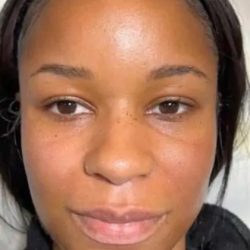 Dermal Fillers Before & After Patient #955