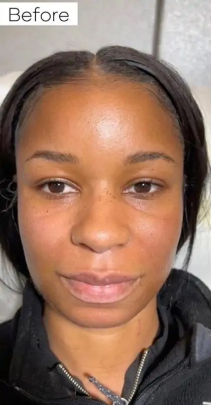 Dermal Fillers Before & After Patient #955