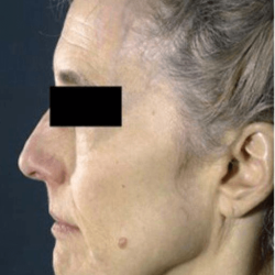Neck Lift Before & After Patient #631