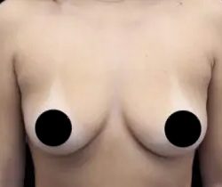 Breast Augmentation Before & After Patient #426