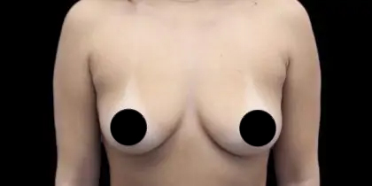 Breast Augmentation Before & After Patient #426