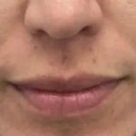 Dermal Fillers Before & After Patient #956