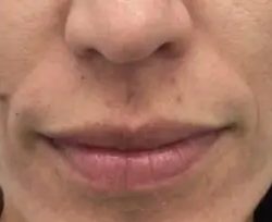 Dermal Fillers Before & After Patient #956