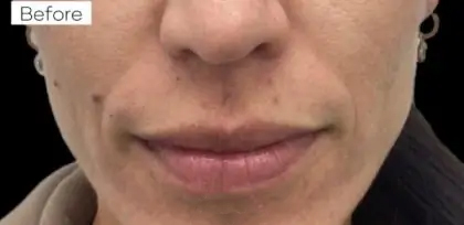 Dermal Fillers Before & After Patient #956