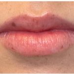 Dermal Fillers Before & After Patient #957